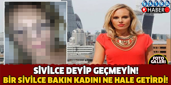 Sivilce Deyip Geçmeyin! Bir Sivilce Bakın Kadını Ne Hale Getirdi?