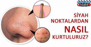 20 dakikada siyah noktaları yok eden karışım !