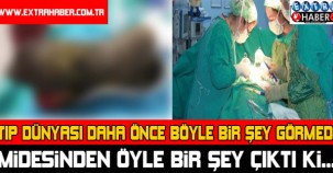 Tıp dünyası daha önce böyle bir şey görmedi! Midesinden öyle bir şey çıktı ki...