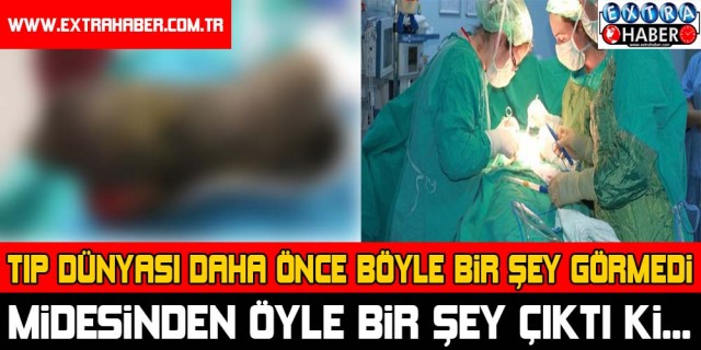 Tıp dünyası daha önce böyle bir şey görmedi! Midesinden öyle bir şey çıktı ki...