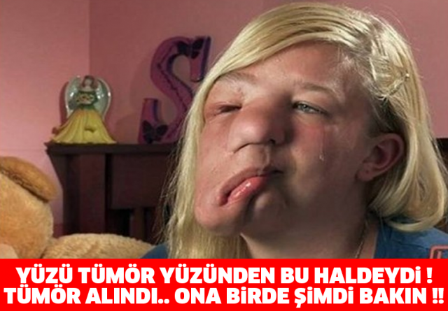 YÜZÜ TÜMÖR YÜZÜNDEN BU HALDEYDİ ! TÜMÖR ALINDI.. ONA BİRDE ŞİMDİ BAKIN !!