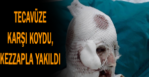 Tecavüze karşı koydu, kezzapla yakıldı