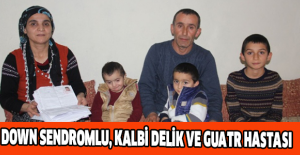 Down sendromlu, kalbi delik ve guatr hastası