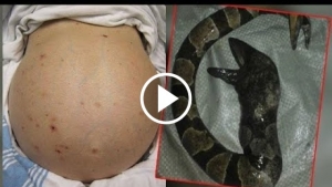 Hamile Sanıldı Fakat Karnından Öyle Birşey Çıktı ki, Doktorlar Görünce İnanmak İstemedi !!